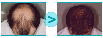 Before / After micrografting