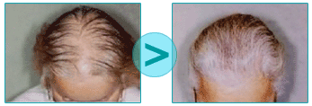 Before / After micrografting