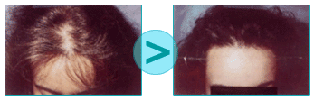 Before / After micrografting